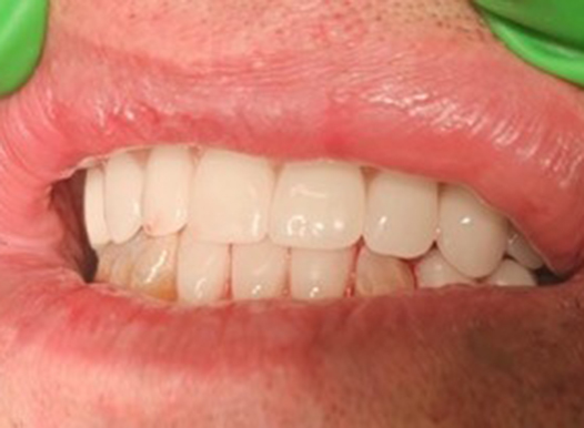 A close-up of a person&rsquo;s mouth after receiving a full arch of bright white, uniform dental veneers or crowns. The upper and lower teeth are perfectly aligned, and the gums appear healthy and pink.