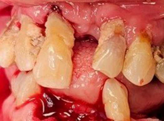 A clinical close-up showing severe dental trauma and decay. The upper teeth are broken, heavily stained, and covered in plaque, with significant bleeding and inflammation of the surrounding gum tissue.