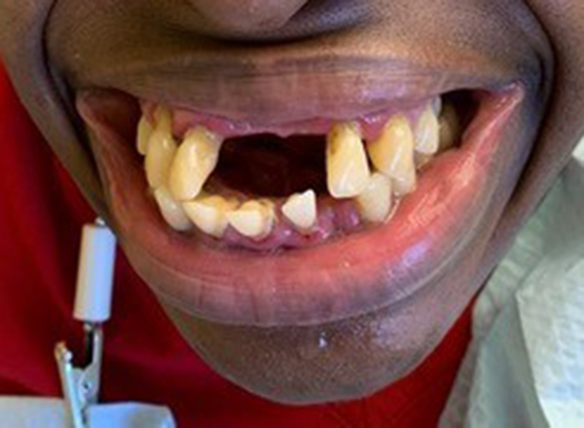 A close-up of a person with a wide smile showing multiple missing upper front teeth and several smaller, widely spaced teeth on the bottom. The open space in the upper jaw reveals the dark interior of the mouth.