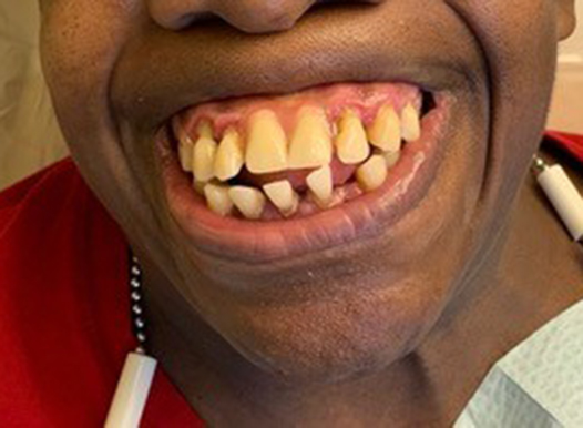 A close-up of the same person smiling, showing a dental restoration. The large gap in the upper teeth has been filled with dental prosthetics that match the color of the remaining natural teeth, creating a more complete smile.