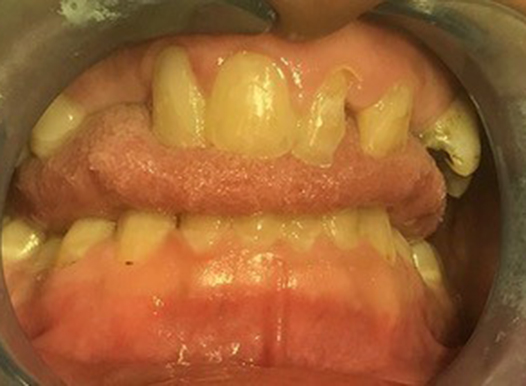 A close-up clinical photo of a patient's mouth showing severely worn, chipped, and misshapen upper teeth with significant gaps. The gums appear thickened and pale pink.