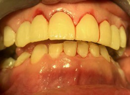A close-up of a patient after receiving dental crowns on the upper arch. The new teeth are uniform, straight, and light in color, though the gum line shows slight redness and irritation from the procedure.
