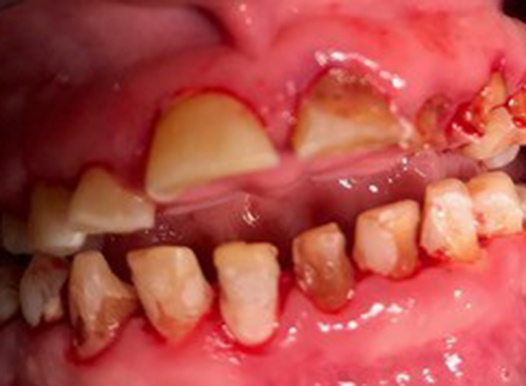 A clinical close-up showing severe dental decay and gum disease. The teeth are heavily eroded, broken, and stained brown, while the surrounding gum tissue is bright red, swollen, and bleeding.