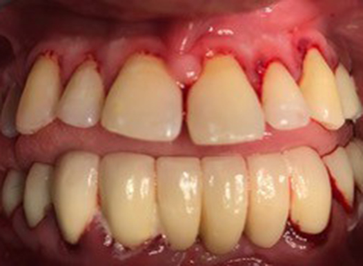 A close-up of a dental restoration in progress. The upper and lower teeth have been fitted with temporary crowns or veneers. The gum line shows some redness and minor bleeding from recent dental work, but the teeth are now uniform in shape.