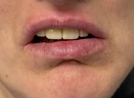 A close-up of a person from the third image after dental restoration. Their mouth is slightly open, revealing a restored set of front teeth that look natural and uniform in color and shape.