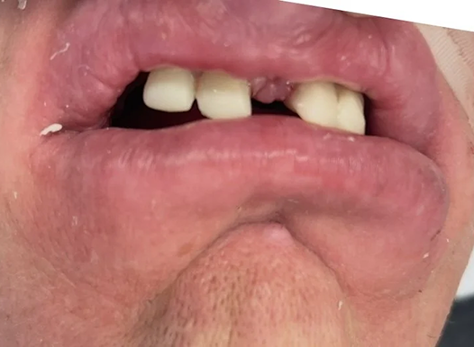 A close-up of a person with significant dental issues, showing several missing and broken front teeth. The gums appear inflamed, and the lips are slightly pursed, highlighting the dental gaps.