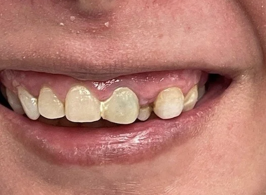 A close-up of a patient’s smile showing several dental issues, including a graying, discolored front tooth and a missing tooth on the upper left side. The gum line appears uneven across the upper arch.