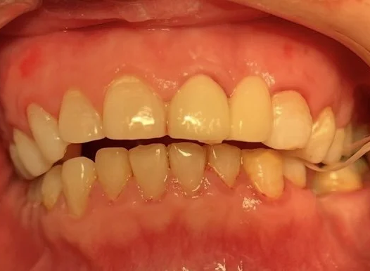 A close-up view of a person’s teeth and gums. The teeth are yellowish in color, and there is visible gum recession and inflammation (redness) along the upper gum line.