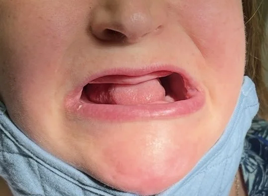 A close-up of a person’s face from the nose to the chin with their mouth open, showing a complete absence of upper and lower teeth (edentulous). They are wearing a blue medical mask pulled down around their neck.