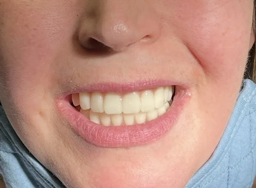A close-up of a person smiling broadly, now wearing a full set of bright white, straight dentures or dental implants. The teeth are perfectly aligned, and the person is wearing the same blue medical mask around their neck.