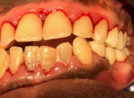 A close-up of a patient&rsquo;s teeth featuring yellowish dental crowns on the upper arch. The lower natural teeth show some wear and unevenness, and the upper gum line is notably red and inflamed.