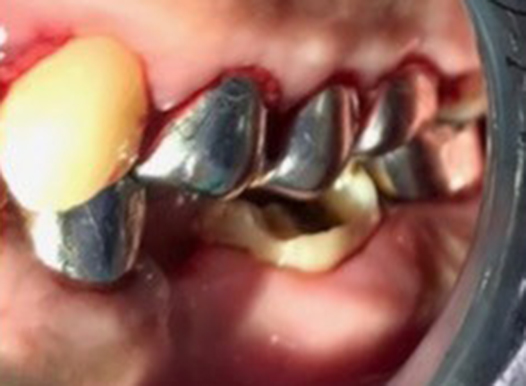 A close-up view of a dental procedure showing several metal abutments or silver-colored temporary crowns placed along the upper gum line. There is visible redness and minor bleeding around the surgical sites.