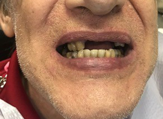 A close-up of an older man's face from the nose to the chin. He has several missing upper front teeth, creating a large gap in his smile. The remaining teeth show signs of yellowing and wear.