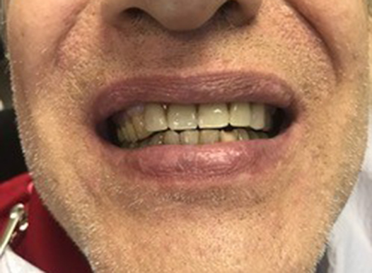 A close-up of an elder man, showing a completed dental restoration. The missing upper teeth have been replaced with a bridge or partial denture that matches the color and shape of his natural teeth.